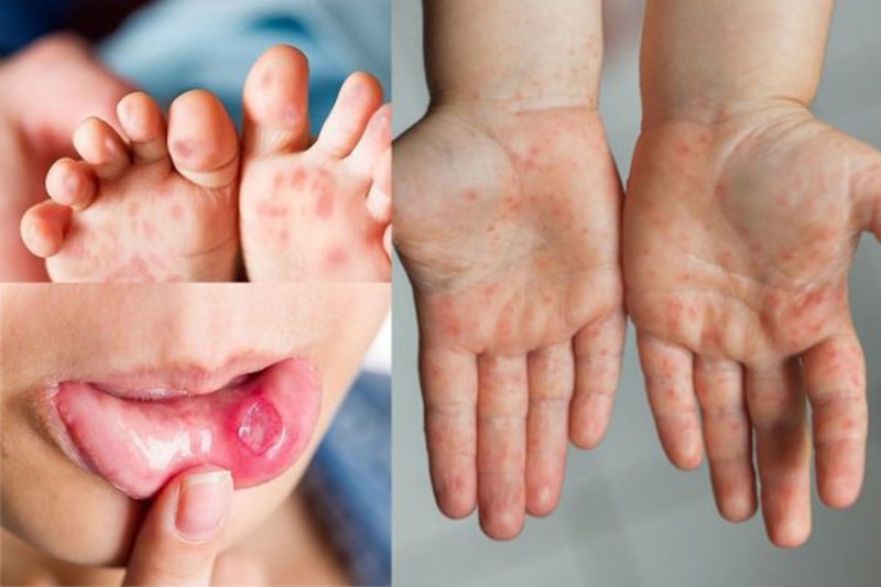 Bệnh tay chân miệng ở trẻ em | Triệu chứng và cách điều trị