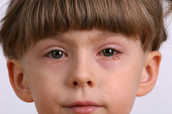 dấu hiệu bệnh đau mắt đỏ