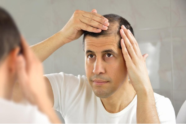Bệnh hói đầu có di truyền không ?