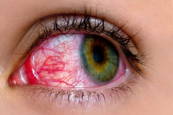 bệnh đau mắt đỏ là gi