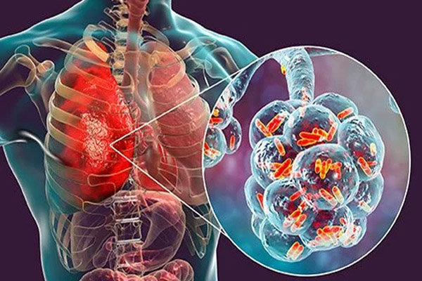 Viêm phổi – Nguyên nhân, Triệu chứng và cách điều trị
