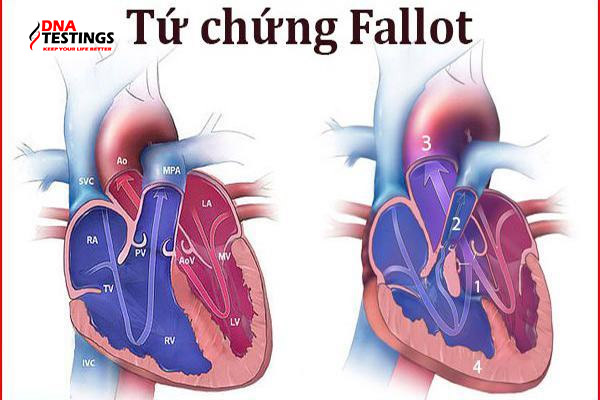 Bệnh tim bẩm sinh tứ chứng Fallot: Nguyên nhân, triệu chứng và điều trị