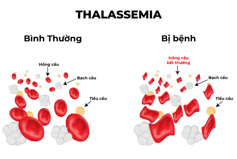 Bệnh Thalassemia tan máu bẩm sinh là gì?