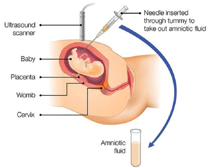 xét nghhiệm qf pcr là gì