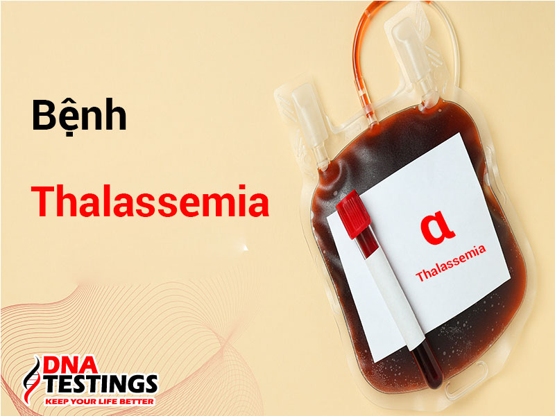 Bệnh alpha Thalassemia: Nguyên nhân, triệu chứng, cách phòng ngừa