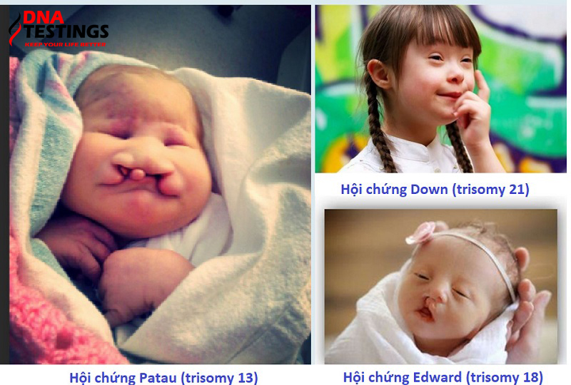 các hội chứng phát hiện được qua xét nghiệm double test và triple test