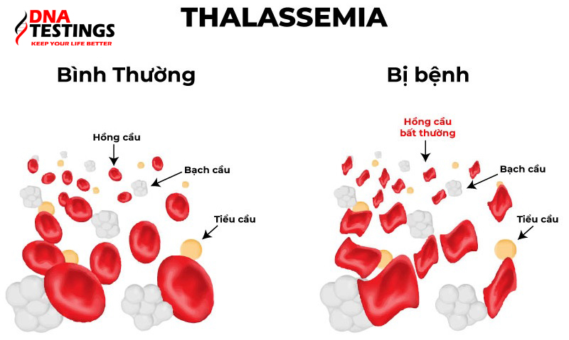 người mắc bệnh Thalassemia thể nhẹ