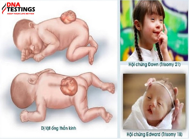 khả năng sàng lọc triple test