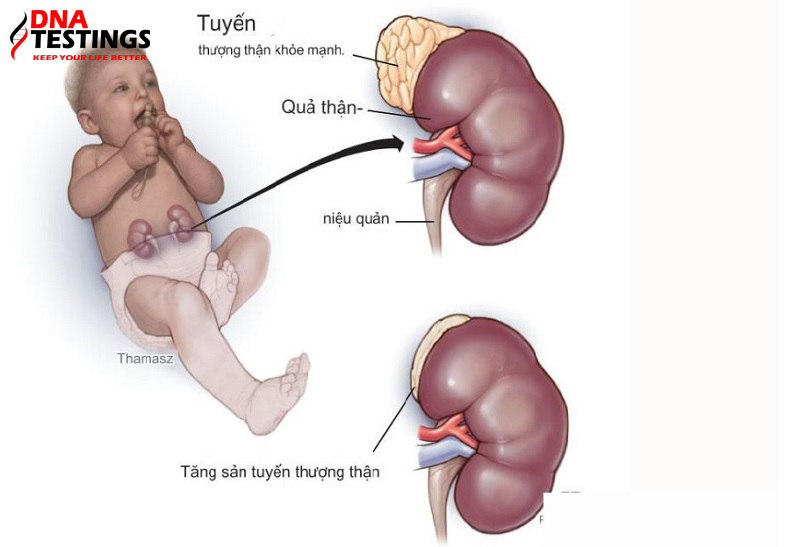 tăng sản tuyến thượng thận